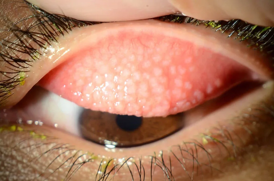 Gigantopapilláris conjunctivitis (GPC) macskakő-szerű duzzanata.